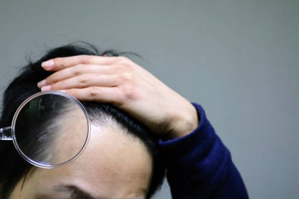 AGAに悩む男性